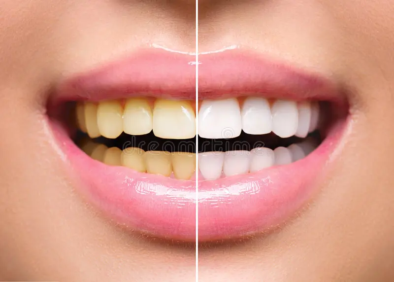 Teeth Model